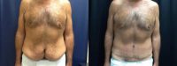45-54 year old man treated with Male Tummy Tuck