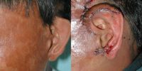 17 or under year old man treated with Ear Surgery- reconstruction