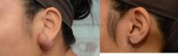 18-24 year old woman treated with keloid removal and ear lobe reconstruction