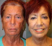 65-74 year old woman: Facelift, fat grafting, upper and lower blepharoplasty