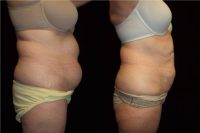 45-54 year old woman treated with Laser Liposuction