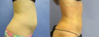 Liposuction: Upper abs, Lower abs, Waist