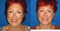 68 year old woman following facelift, eyelid surgery, and liposuction of the neck
