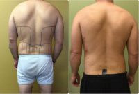 35-44 year old man treated with Smart Lipo