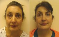 facelift with eyelift