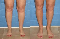 52 year old woman treated with Liposuction for Cankles