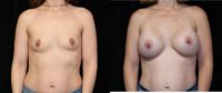 25-34 year old woman treated with Breast Augmentation