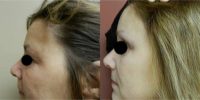 35-44 year old woman treated with Brow Lift