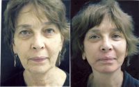 73-year-old before and after full face lift and chemical peel, laser