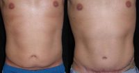 Male tummy Tuck, Flank Liposuction