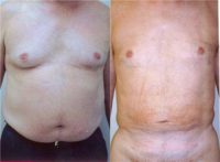58 year old man treated with Liposuction