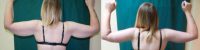 18-24 year old woman treated with Arm Lift