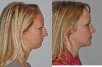 Cosmetic Chin Surgery