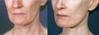 55-64 year old woman treated with Facelift and neck lift
