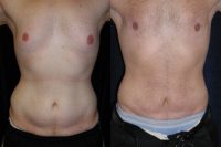 Male Tummy Tuck, Flank Liposuction, Male Breast Reduction