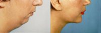 Chin Liposuction - Before & After