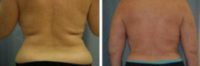 49 years old / liposuction of back folds.