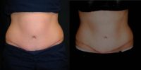 25-34 year old woman treated with SculpSure