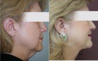 55-64 year old woman treated with Neck Liposuction