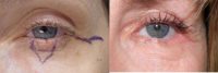 35-44 year old woman treated with Eyelid Cancer Removal Surgery