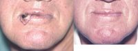 45-54 year old man treated with Lip Cancer Removal