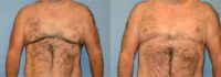40 year old man treated with Male Breast Reduction