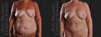 nilateral (left) mastectomy with immediate DIEP Flap; fat grafting; nipple reconstruction and areola pigmentation