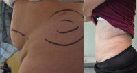 35-44 year old woman treated with Mini Tummy Tuck