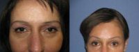45-54 year old woman treated with Eyelid Surgery