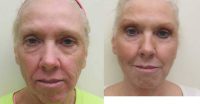 45-54 year old woman treated with Liquid Facelift