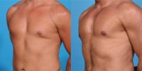 45-54 year old man treated with Pec Implants