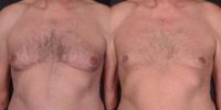 55-64 year old man treated with Gynecomastia Surgery