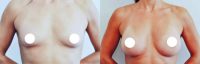35-44 year old man treated with Breast Implants