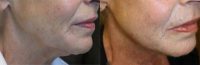 Ultherapy Neck