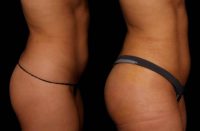 19 year old woman treated with Brazilian Butt Lift under Local Anesthesia