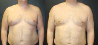 39 year old male treated with Gynecomastia
