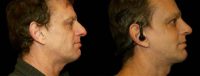 man treated with Facelift