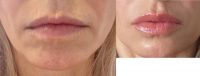 45-54 year old woman treated with Lip Filler for Augmentation