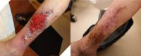 75 and up year old woman treated with Vein Treatment