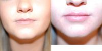 22 year old woman treated with Juvederm