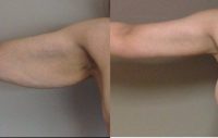 45-54 year old woman treated with Arm Lift
