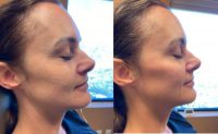 45-54 year old woman treated with Cheek Augmentation