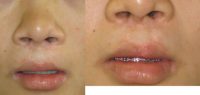 fat injection from abdomen to lip; dermabrasion to nostril scars