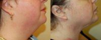 Neck Lift Before and After Pictures