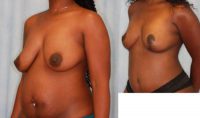 33-year old patient treated with Breast Lift