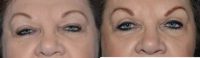 68 year old woman treated with Eyelid Surgery