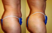 Body Jet (water assisted) liposuction