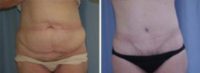 54 years old / status post gastric bypass abdominoplasty.