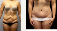 Dr Lynn D. Derby, MD, Spokane Plastic Surgeon - 32 Year Old Woman With A History Of 110lb Weight Loss, Treated With Tummy Tuck