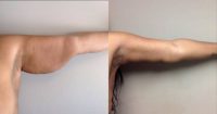 25-34 year old woman treated with Arm Lift